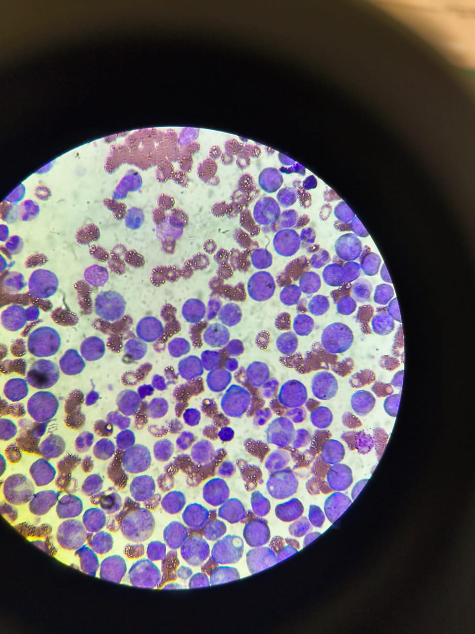 Clinical context for leukaemia-related healthcare and education